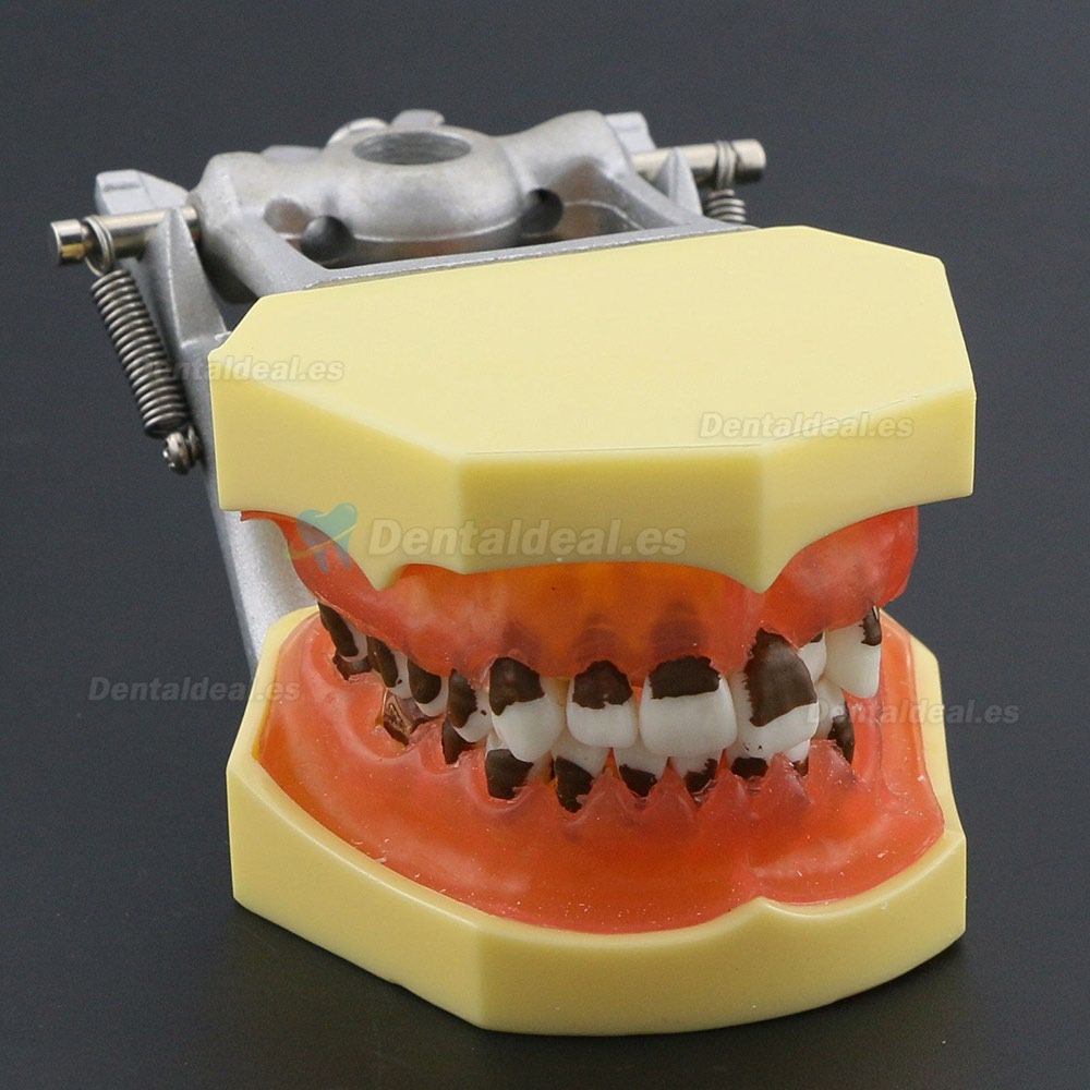 Modelo de enfermedad de periodontosis dental demuestra inflamación gingivale calculs 4003