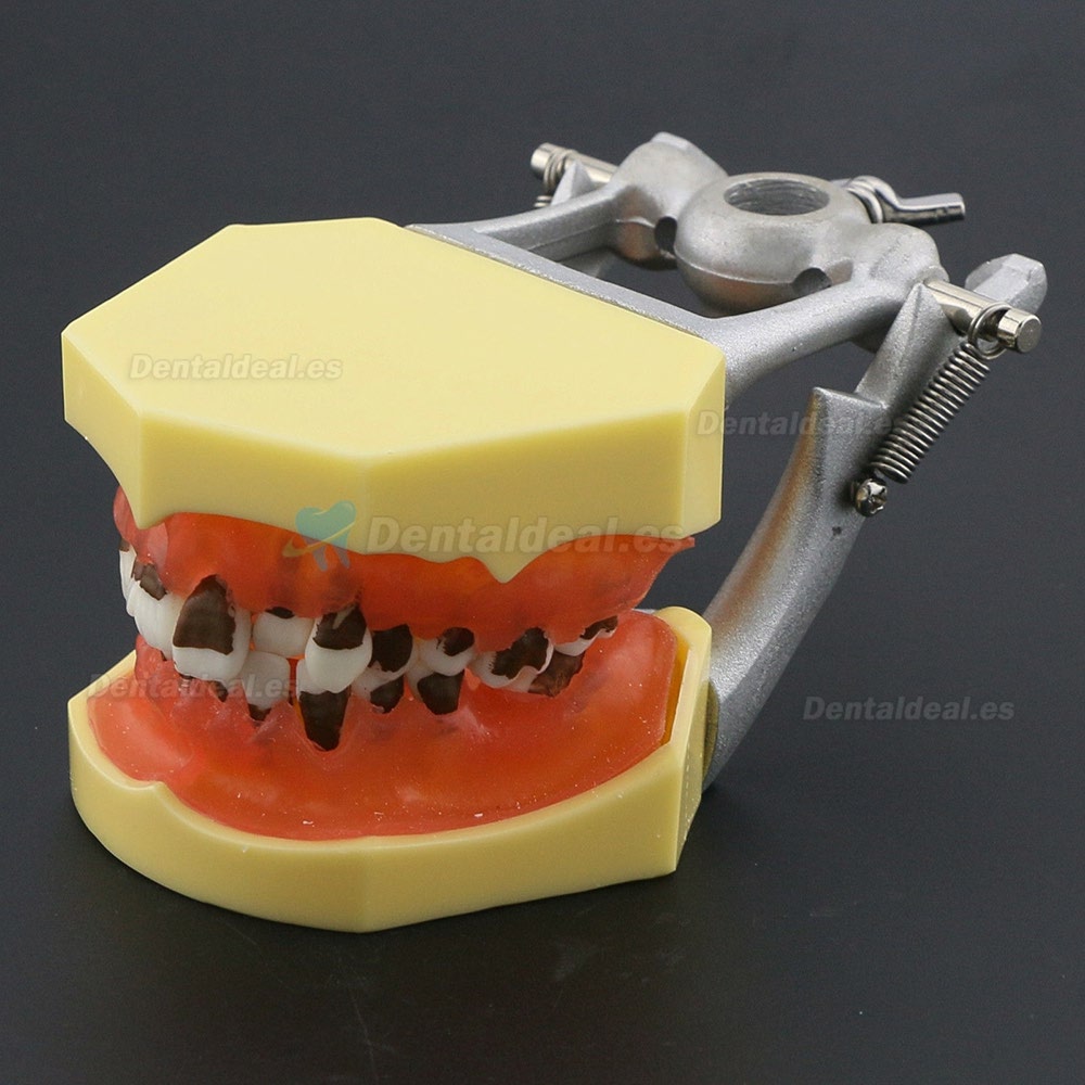 Modelo de enfermedad de periodontosis dental demuestra inflamación gingivale calculs 4003