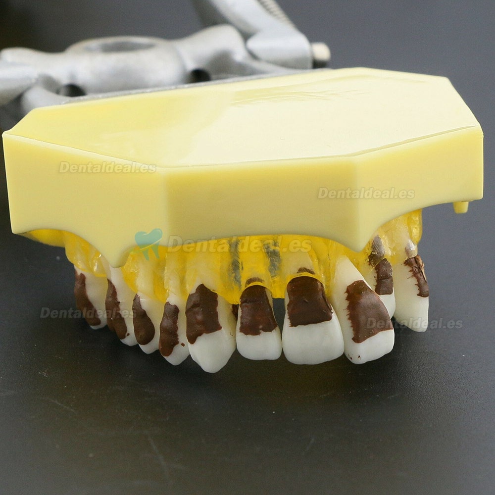 Modelo de enfermedad de periodontosis dental demuestra inflamación gingivale calculs 4003