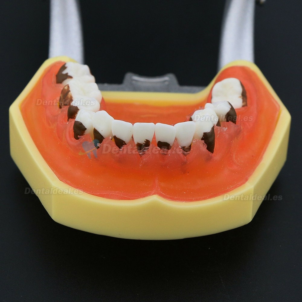 Modelo de enfermedad de periodontosis dental demuestra inflamación gingivale calculs 4003
