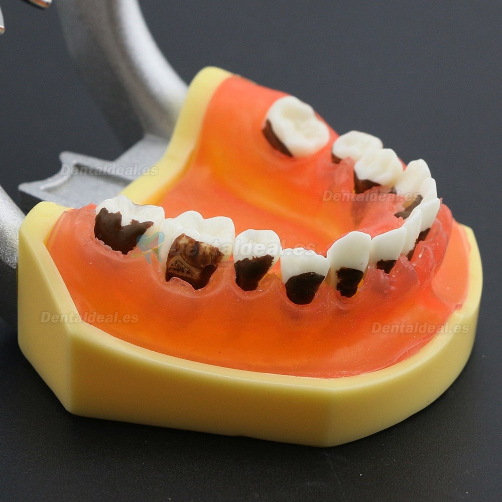 Modelo de enfermedad de periodontosis dental demuestra inflamación gingivale calculs 4003