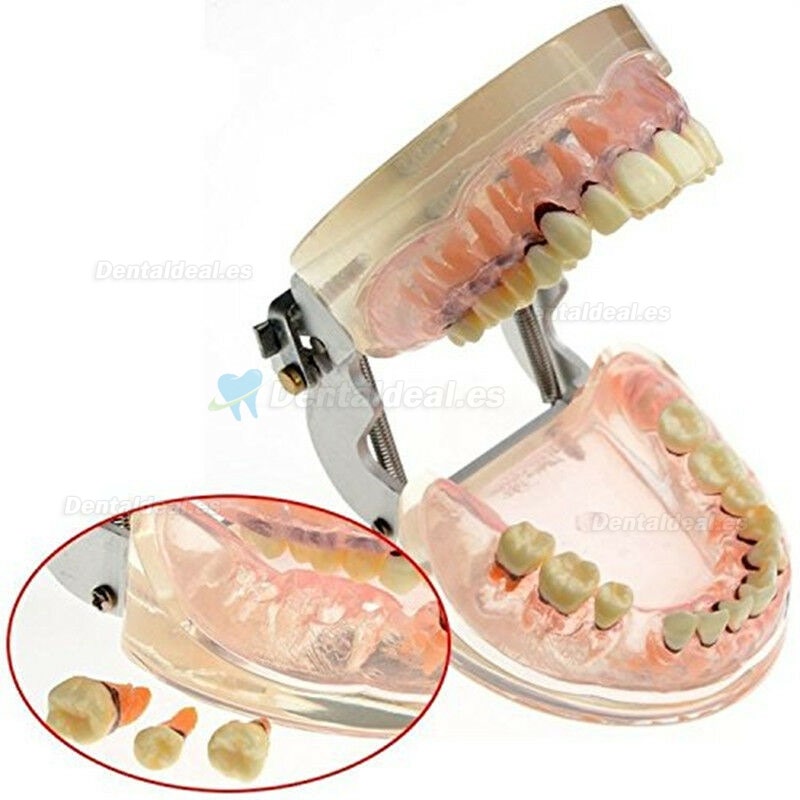 Modelo dental Estudio de la enfermedad periodontal patológica en adultos Modelo de dientes 4017