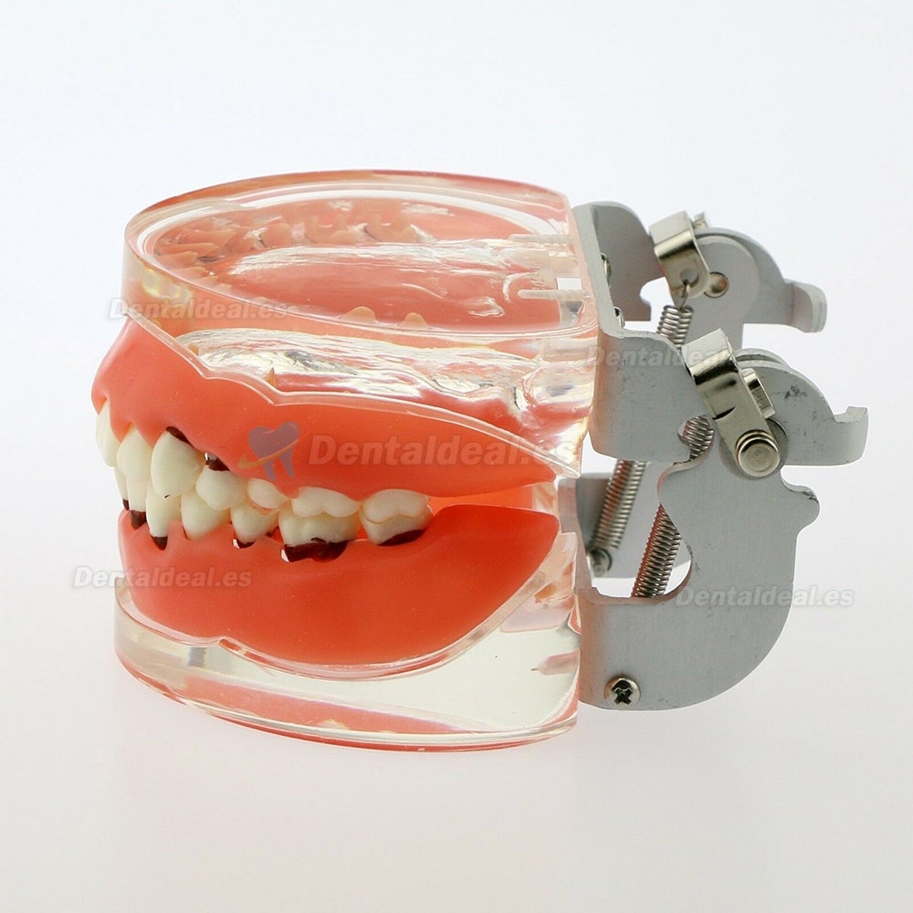 Modelo dental Estudio de la enfermedad periodontal patológica en adultos Modelo de dientes 4017