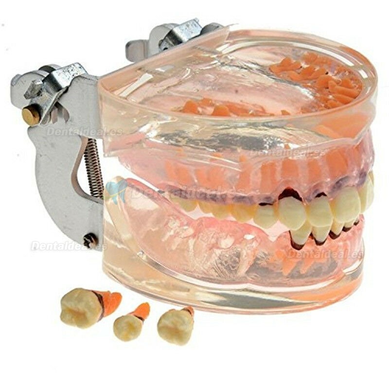 Modelo dental Estudio de la enfermedad periodontal patológica en adultos Modelo de dientes 4017