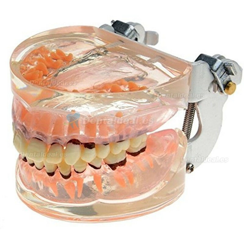 Modelo dental Estudio de la enfermedad periodontal patológica en adultos Modelo de dientes 4017