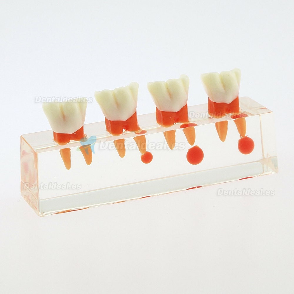 Modelo de Dientes Dentales Estudio de Tratamiento Endodóntico en 4 Etapas Modelo de Enseñanza 4018 01