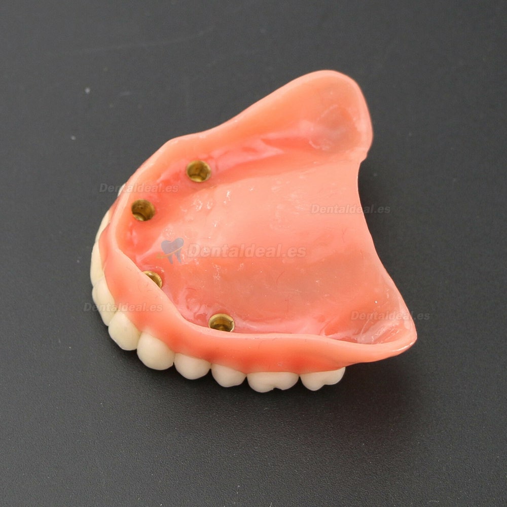 Dental 4 implantes Demostración Superior Modelo de sobredentadura superior 6001 01