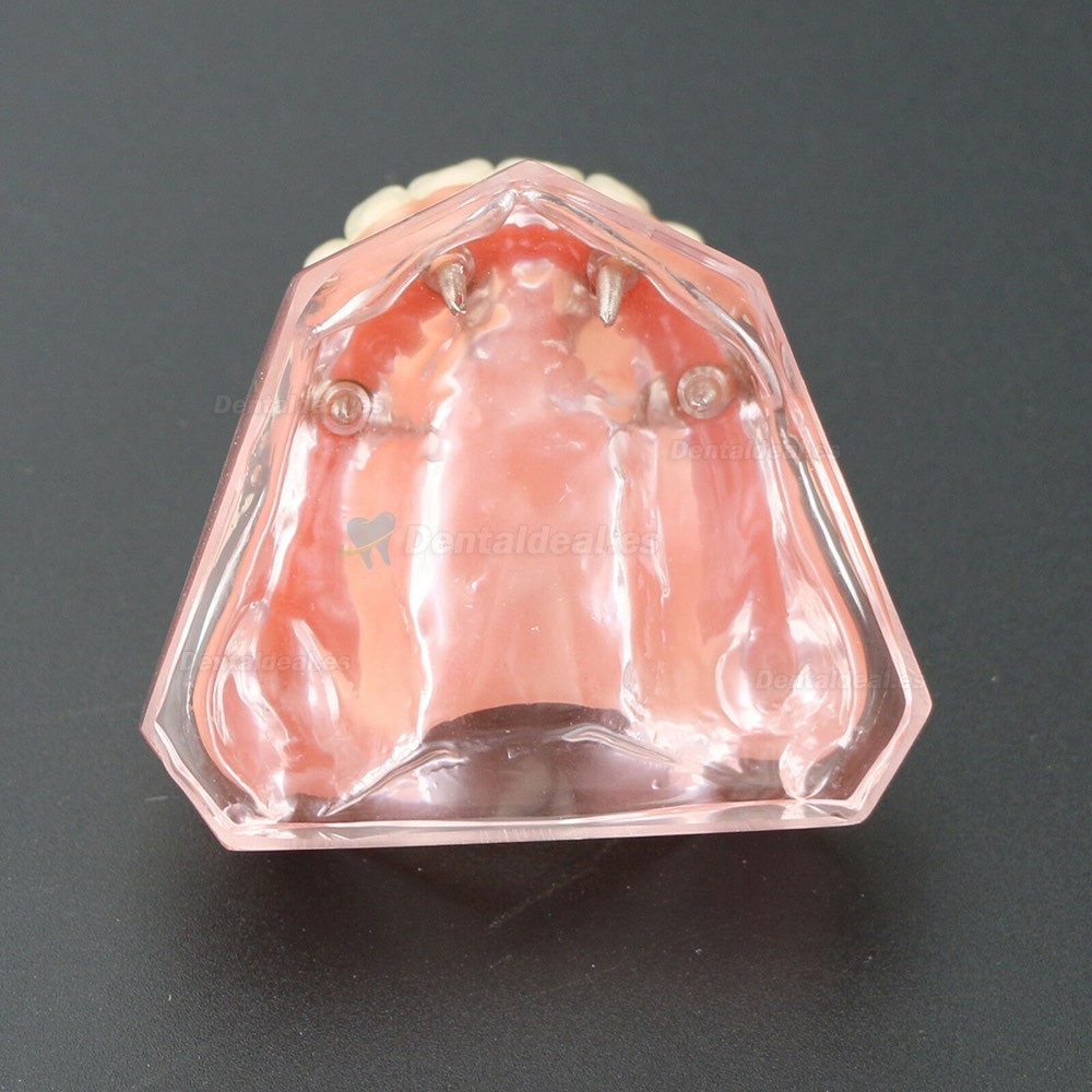 Dental 4 implantes Demostración Superior Modelo de sobredentadura superior 6001 01