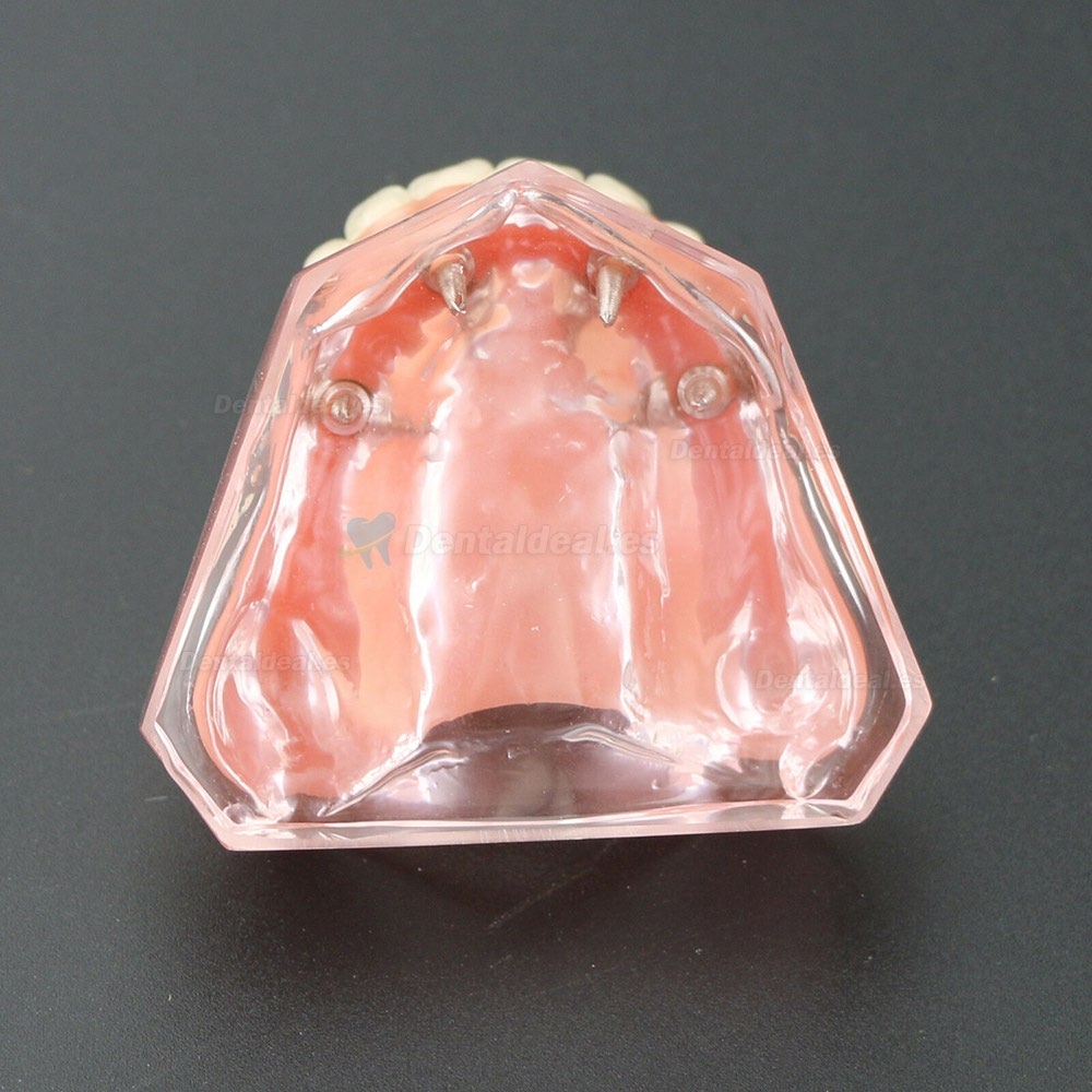 Dental 4 implantes Demostración Modelo de sobredentadura 6001 01
