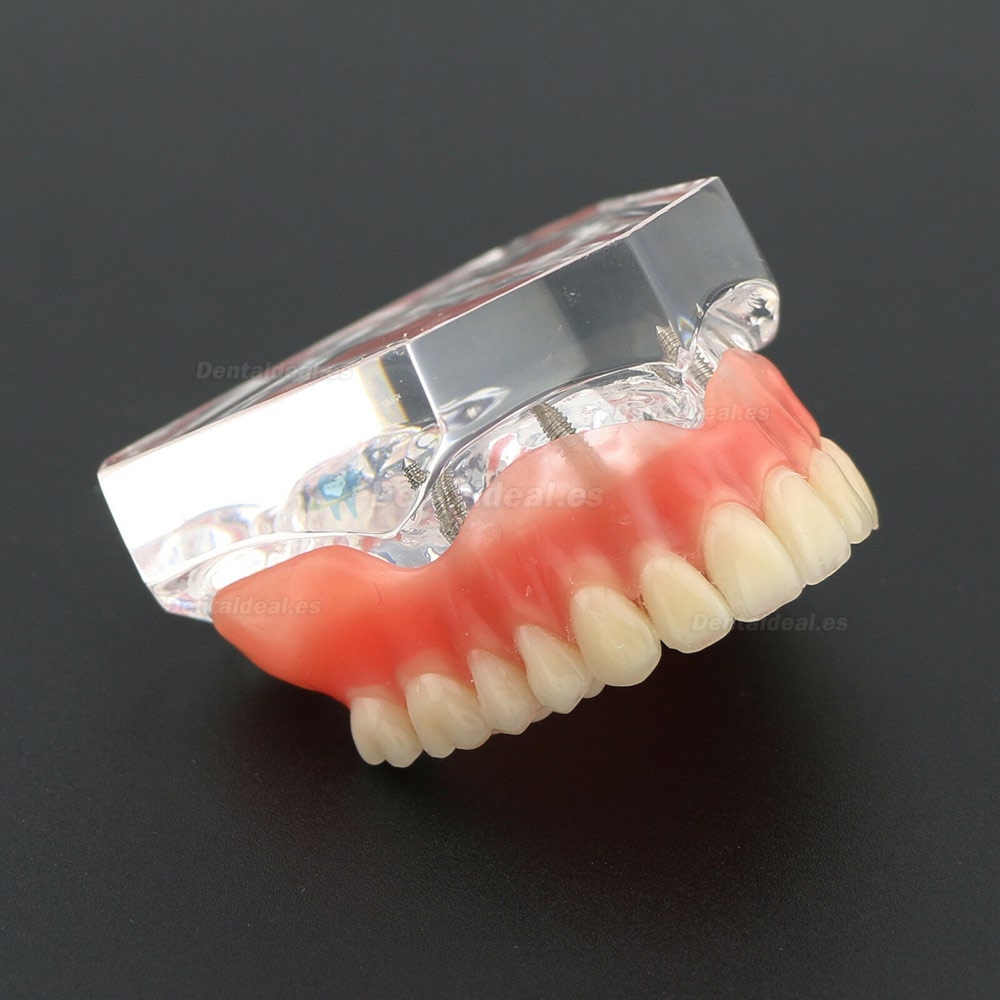 Diente superior dental Modelo de sobredentadura para implantes de 4 implantes superior Modelo 6001 02