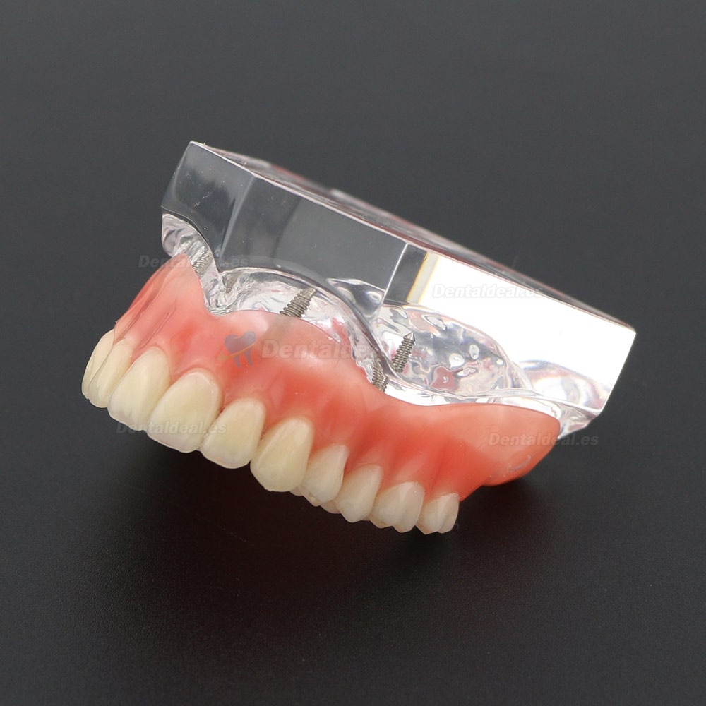 Diente superior dental Modelo de sobredentadura para implantes de 4 implantes superior Modelo 6001 02