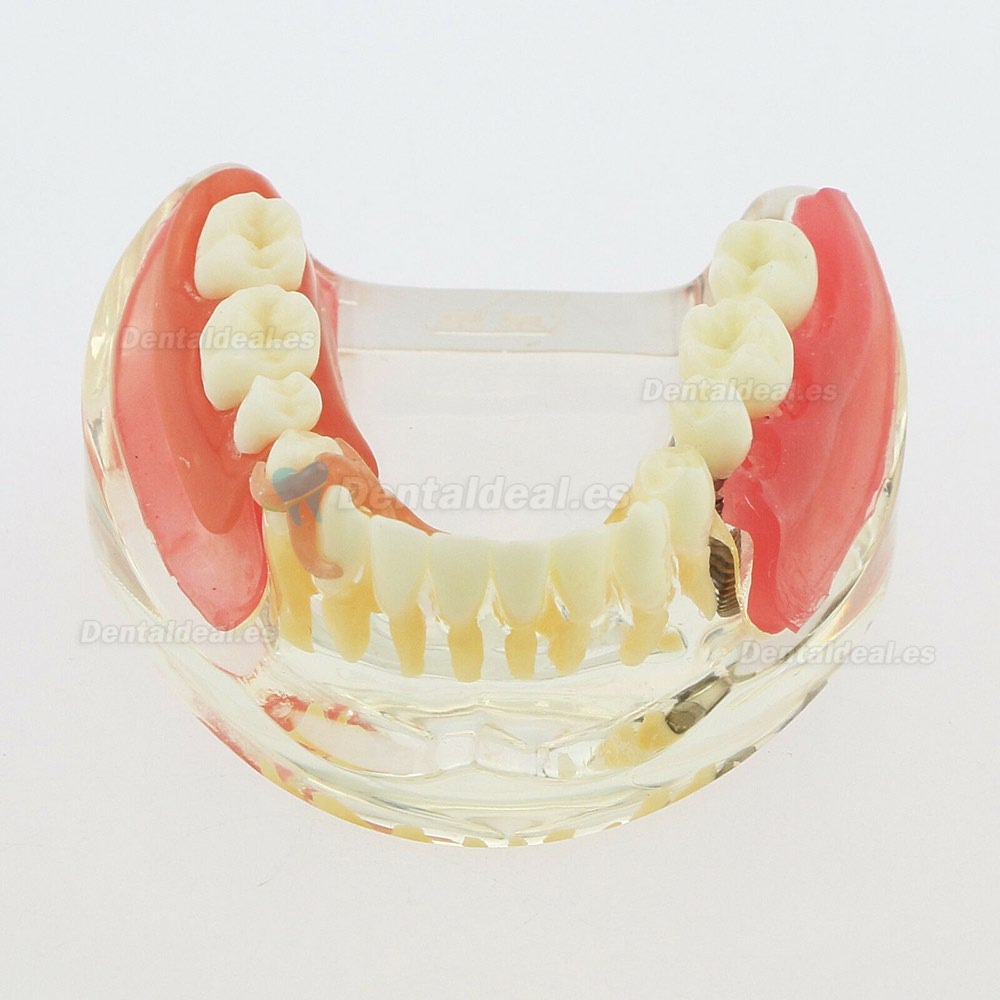 Dental Modelo Inferior Extraíble Restauración Implante Puente Demo Modelo 6006