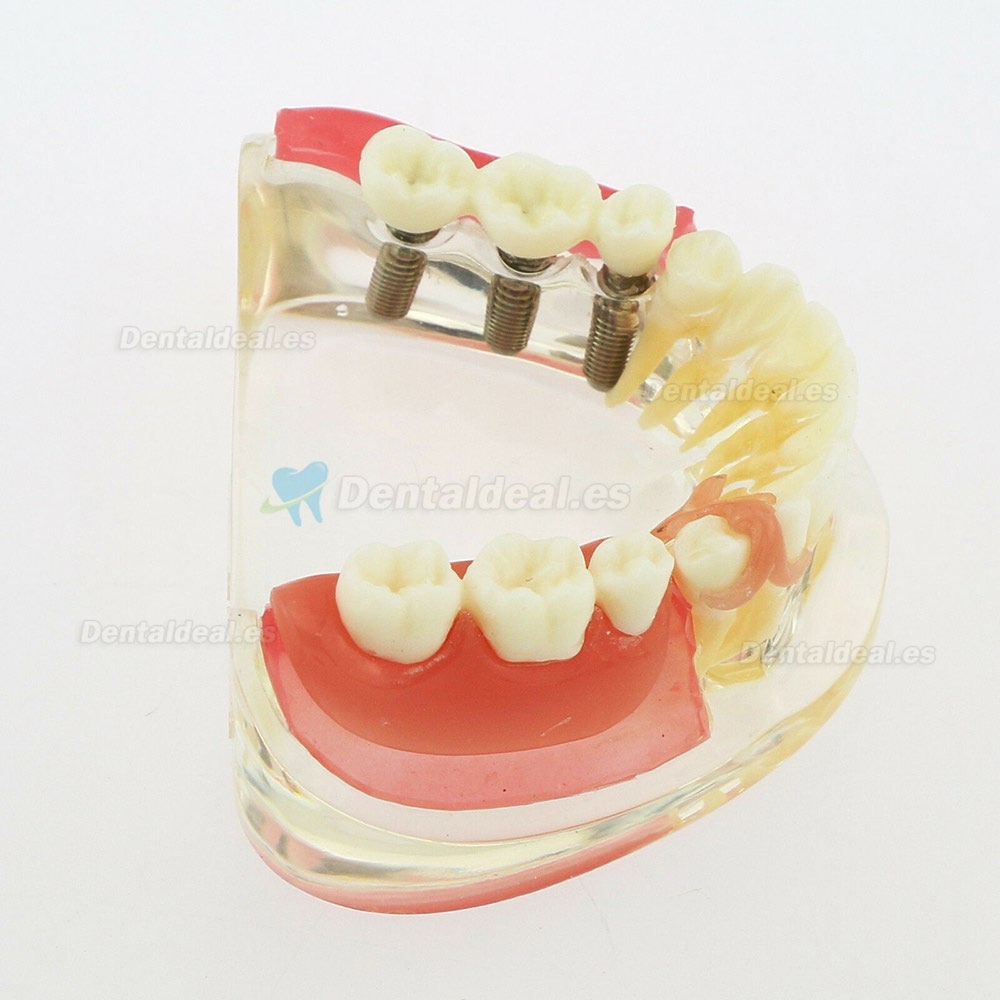 Dental Modelo Inferior Extraíble Restauración Implante Puente Demo Modelo 6006