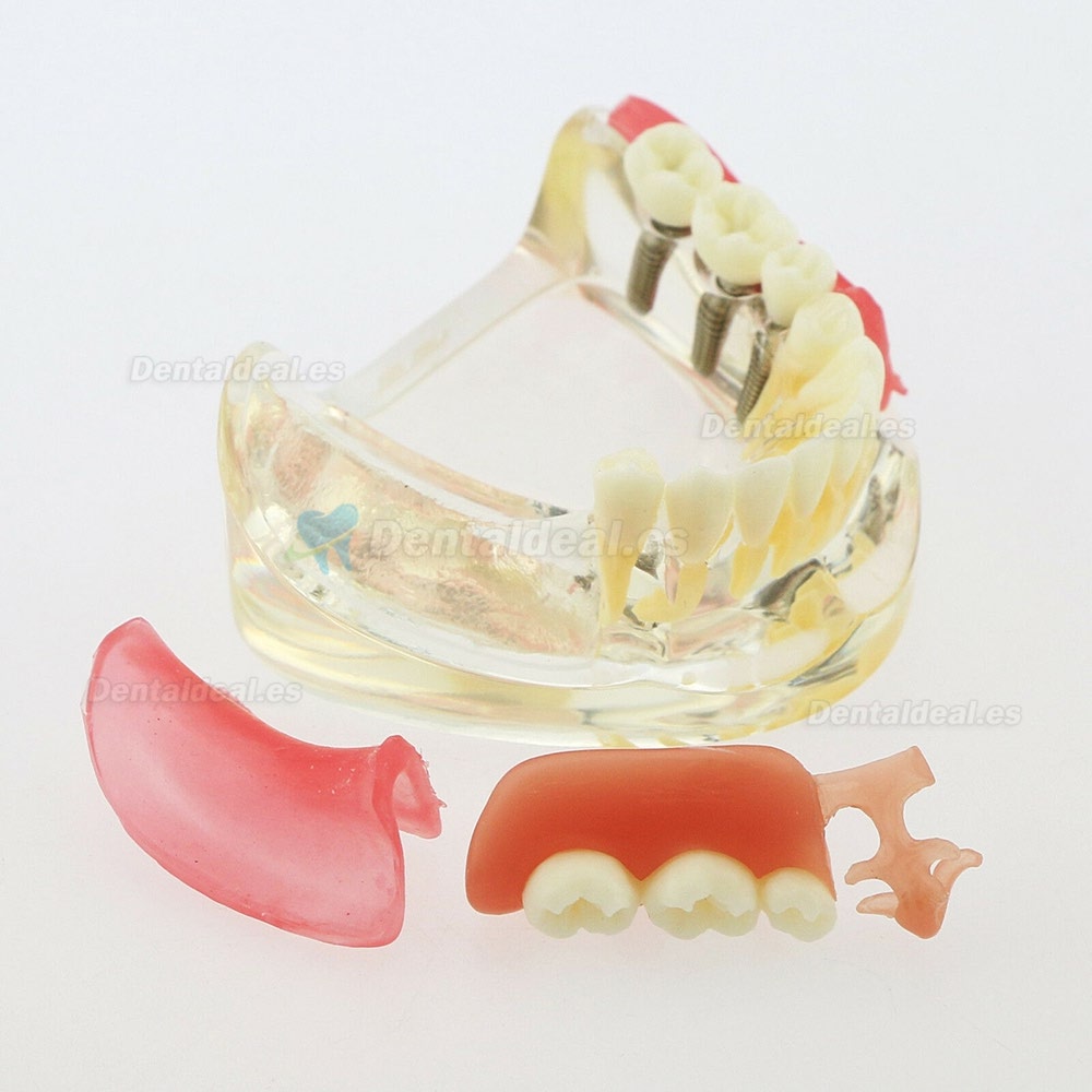 Dental Modelo Inferior Extraíble Restauración Implante Puente Demo Modelo 6006