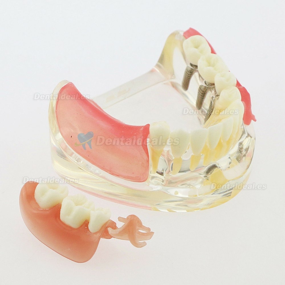 Dental Modelo Inferior Extraíble Restauración Implante Puente Demo Modelo 6006