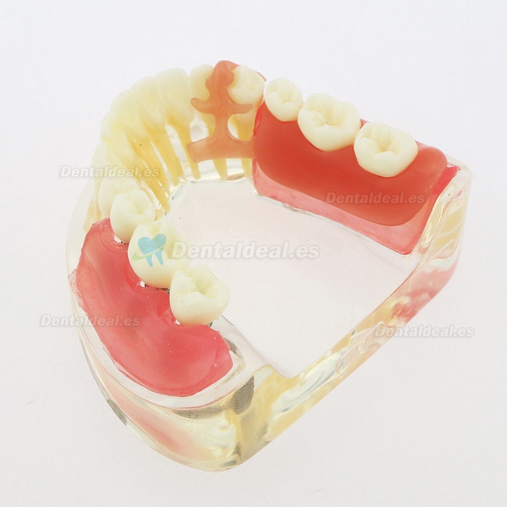 Dental Modelo Inferior Extraíble Restauración Implante Puente Demo Modelo 6006