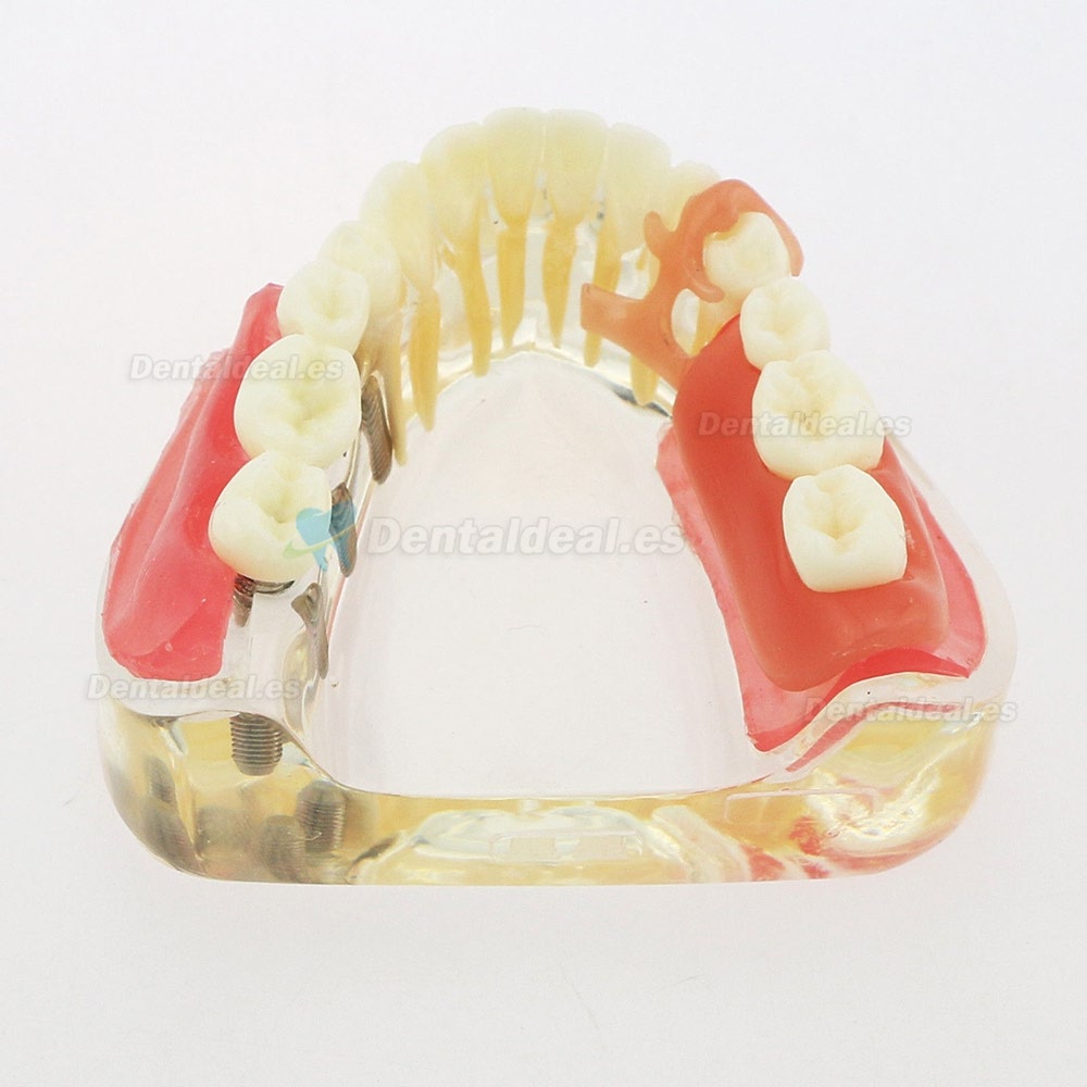 Dental Modelo Inferior Extraíble Restauración Implante Puente Demo Modelo 6006