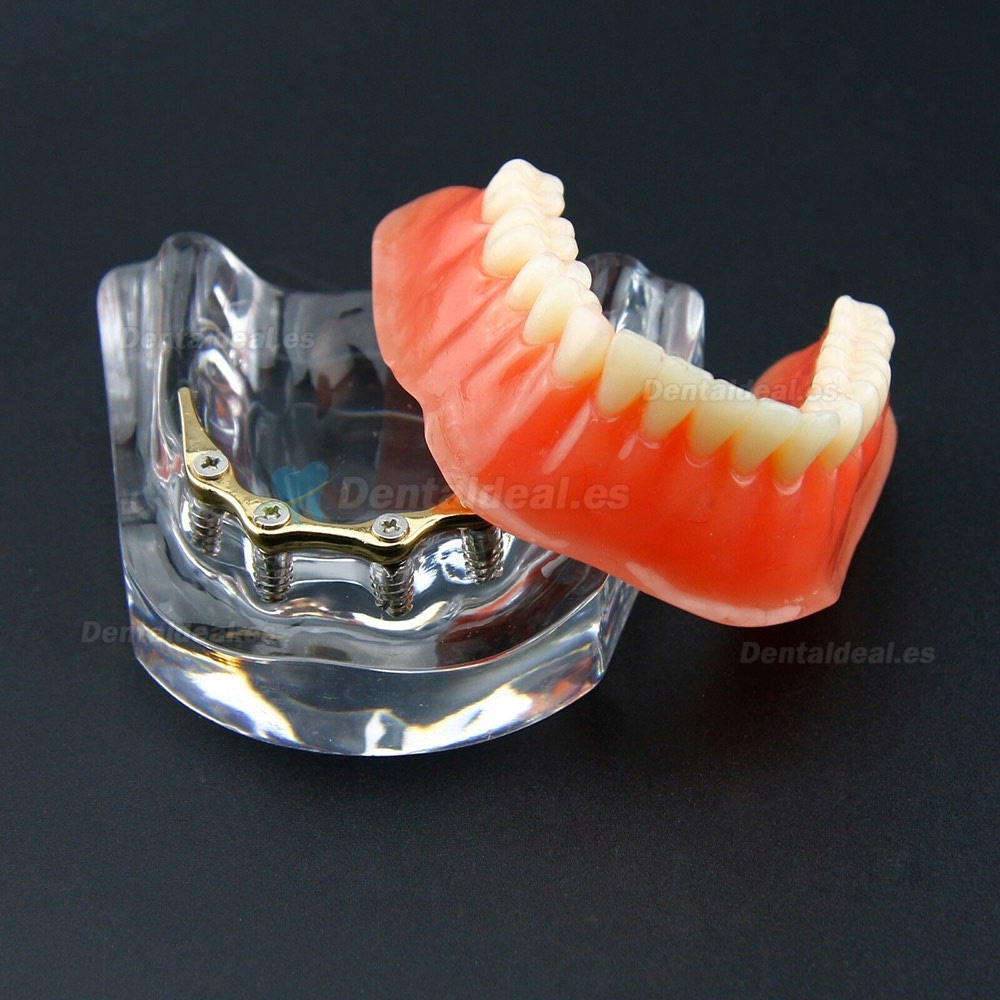 Sobredentadura Dental Typodont Modelo Inferior Precision Implant Dorado 6009