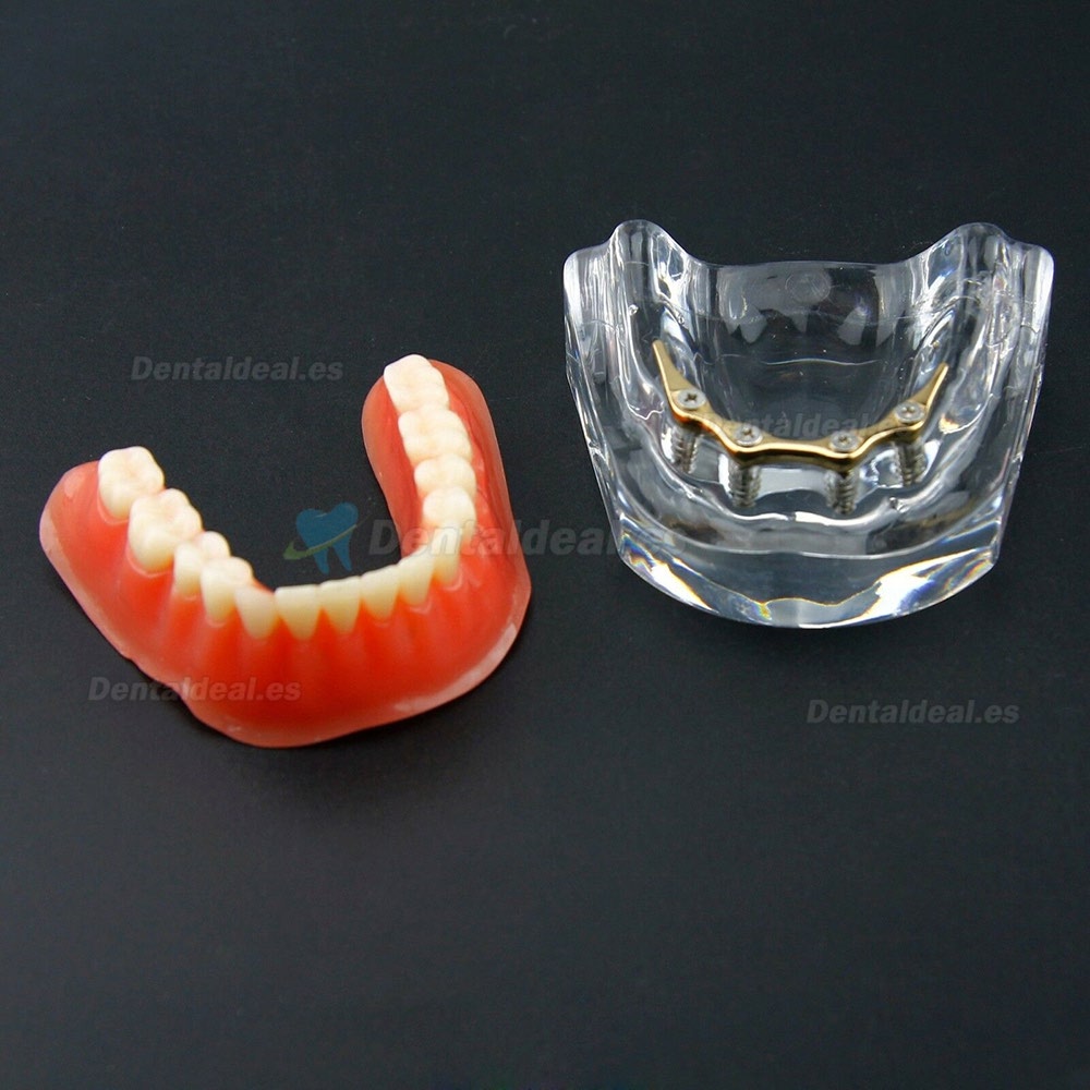 Sobredentadura Dental Typodont Modelo Inferior Precision Implant Dorado 6009