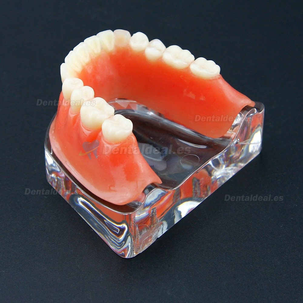 Sobredentadura Dental Typodont Modelo Inferior Precision Implant Dorado 6009