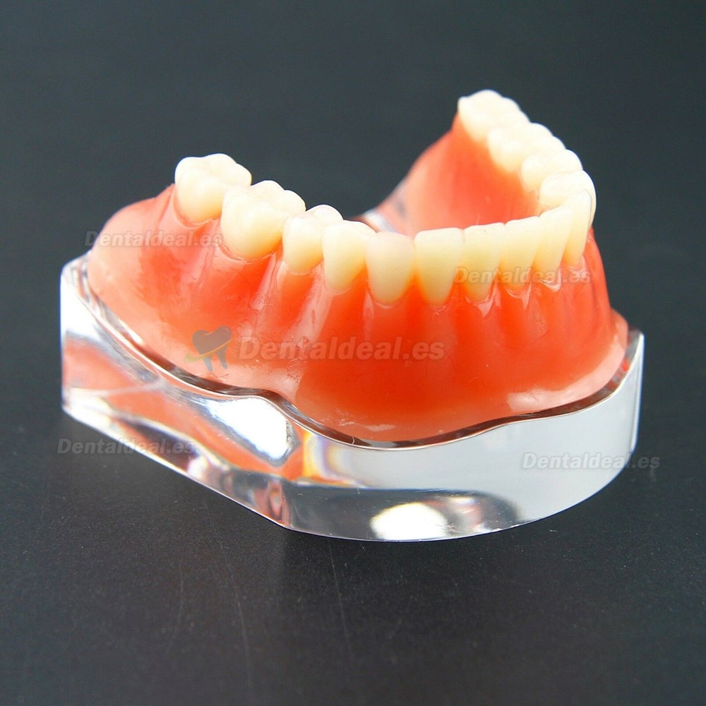 Sobredentadura Dental Typodont Modelo Inferior Precision Implant Dorado 6009