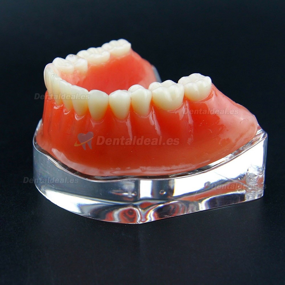 Sobredentadura Dental Typodont Modelo Inferior Precision Implant Dorado 6009