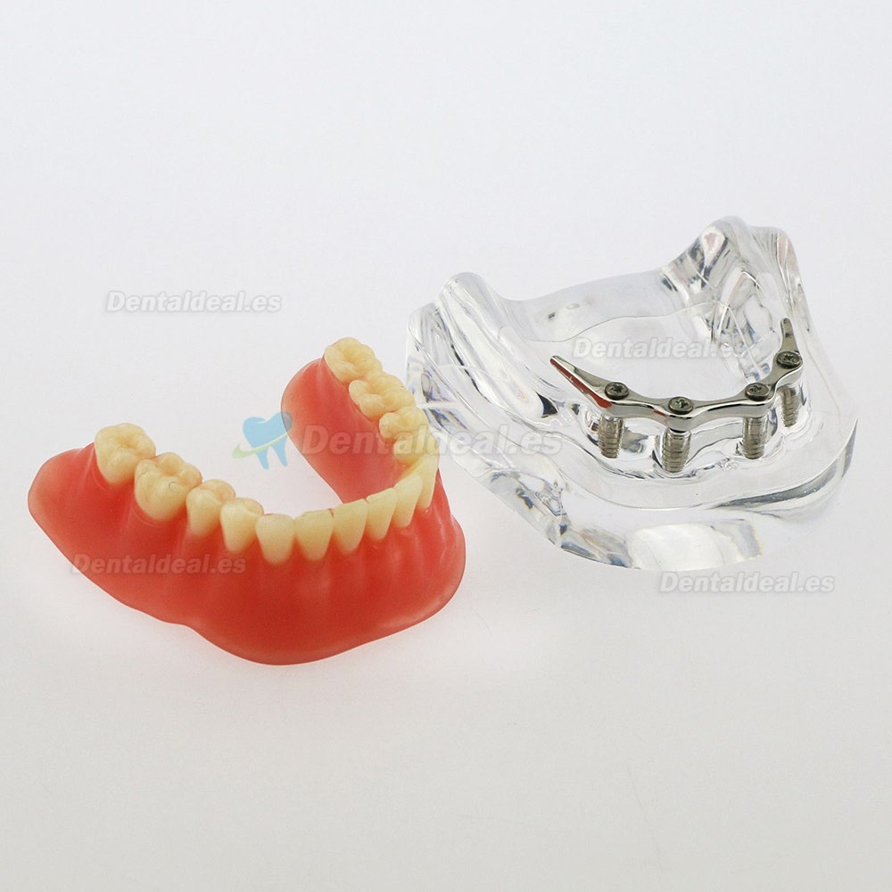 Dental Inferior Modelo de dientes Precisión de sobredentadura 4 implantes Demo Barra plateada