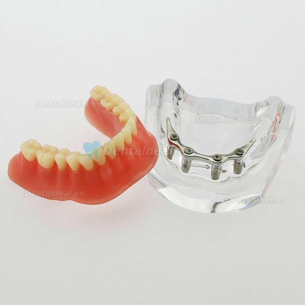 Dental Inferior Modelo de dientes Precisión de sobredentadura 4 implantes Demo Barra plateada