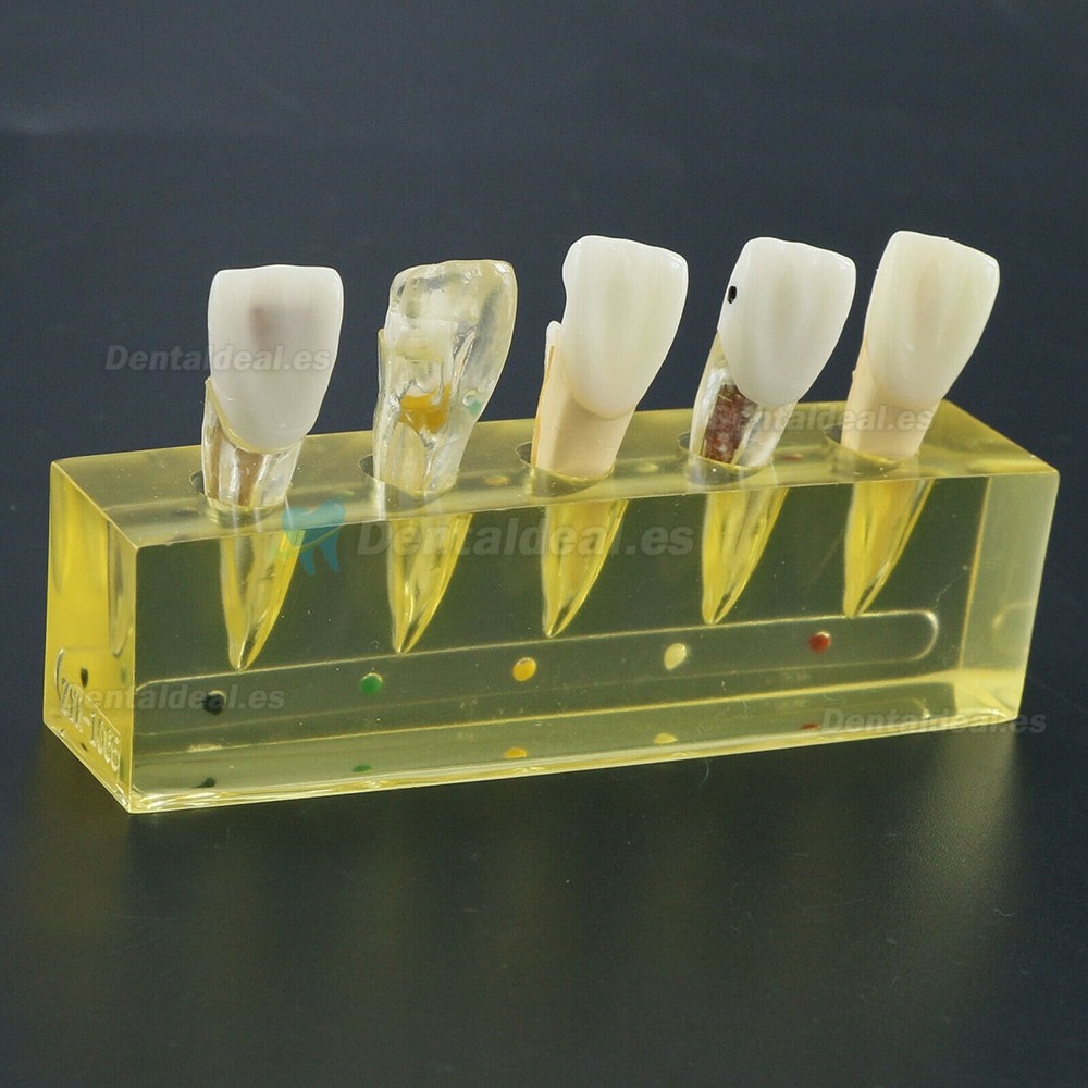 Modelo de dientes dentales 5 etapas Demostración Tratamiento endodóntico Incisivo de conducto radicular