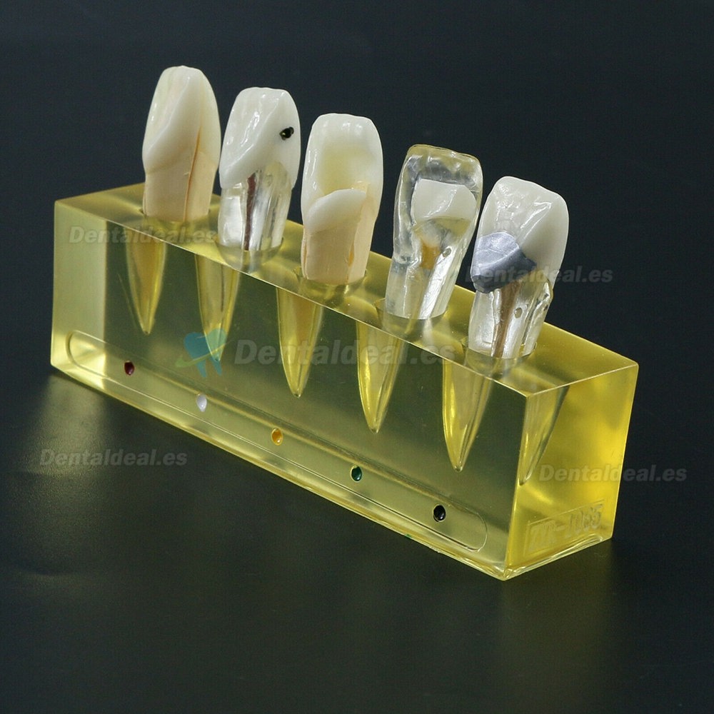 Modelo de dientes dentales 5 etapas Demostración Tratamiento endodóntico Incisivo de conducto radicular