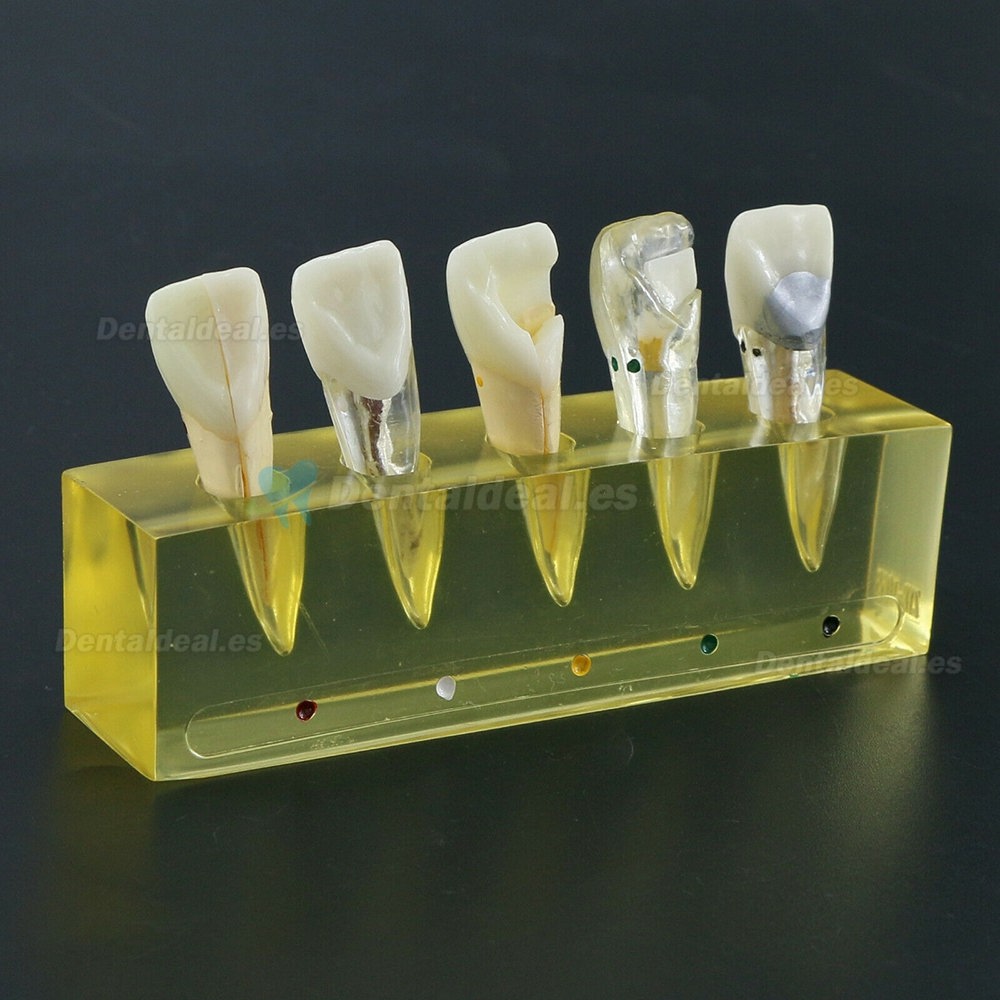 Modelo de dientes dentales 5 etapas Demostración Tratamiento endodóntico Incisivo de conducto radicular