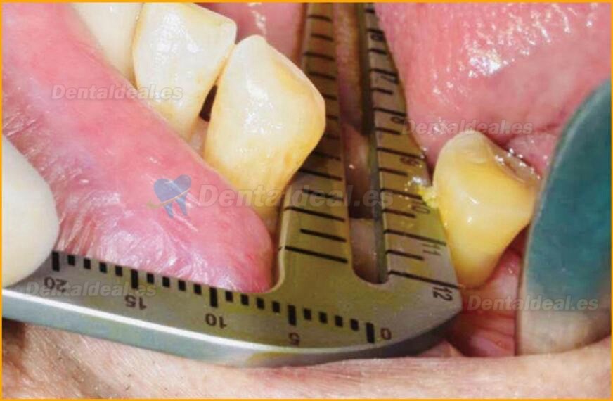 Conjunto de cirugía de implantes dentales acero inoxidable regla de ángulo del instrumento de posicionamiento de plantación oral