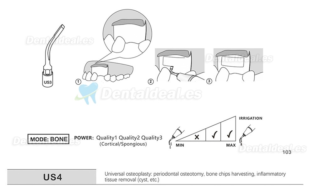 1Pcs Punta Ultrasurgery US1 US1L US1R US2 US3 US4 US5 US6 US7 US11 US12 compatible con Mectron Woodpecker