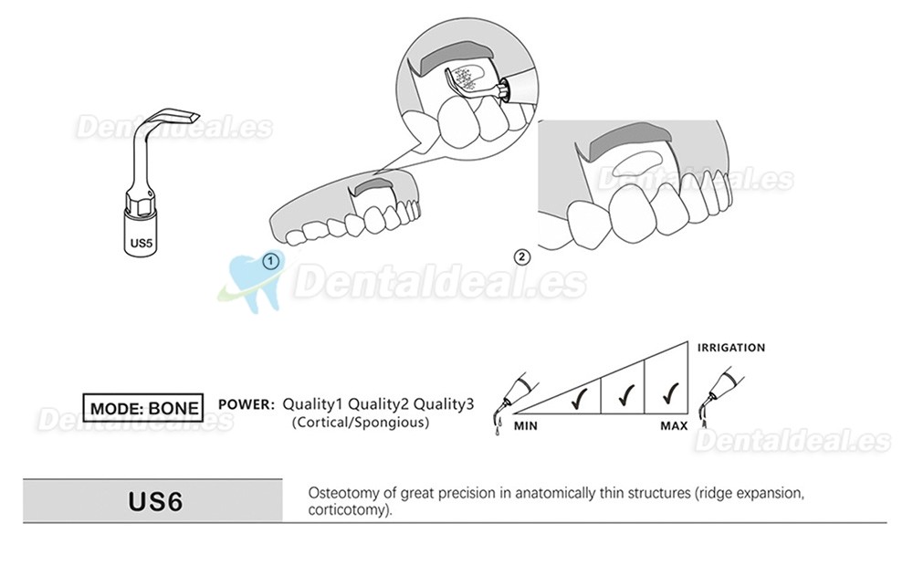 1Pcs Punta Ultrasurgery US1 US1L US1R US2 US3 US4 US5 US6 US7 US11 US12 compatible con Mectron Woodpecker