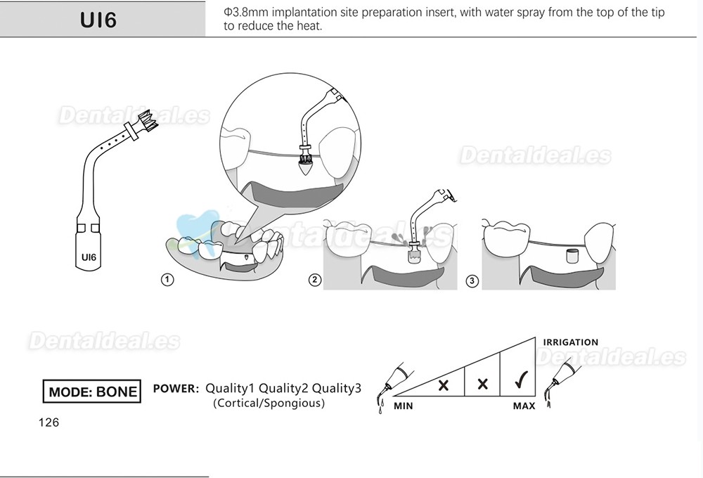 1Pcs Puntas para piezo cirugía para implante de elevación de seno para corte óseo Ul1 UI2 UI3 UI4 UI5 compatible con Mectron Woodpecker