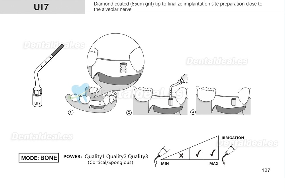 1Pcs Puntas para piezo cirugía para implante de elevación de seno para corte óseo Ul1 UI2 UI3 UI4 UI5 compatible con Mectron Woodpecker