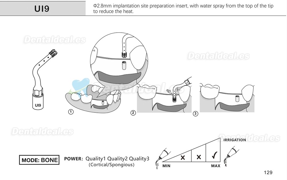 1Pcs Puntas para piezo cirugía para implante de elevación de seno para corte óseo Ul1 UI2 UI3 UI4 UI5 compatible con Mectron Woodpecker