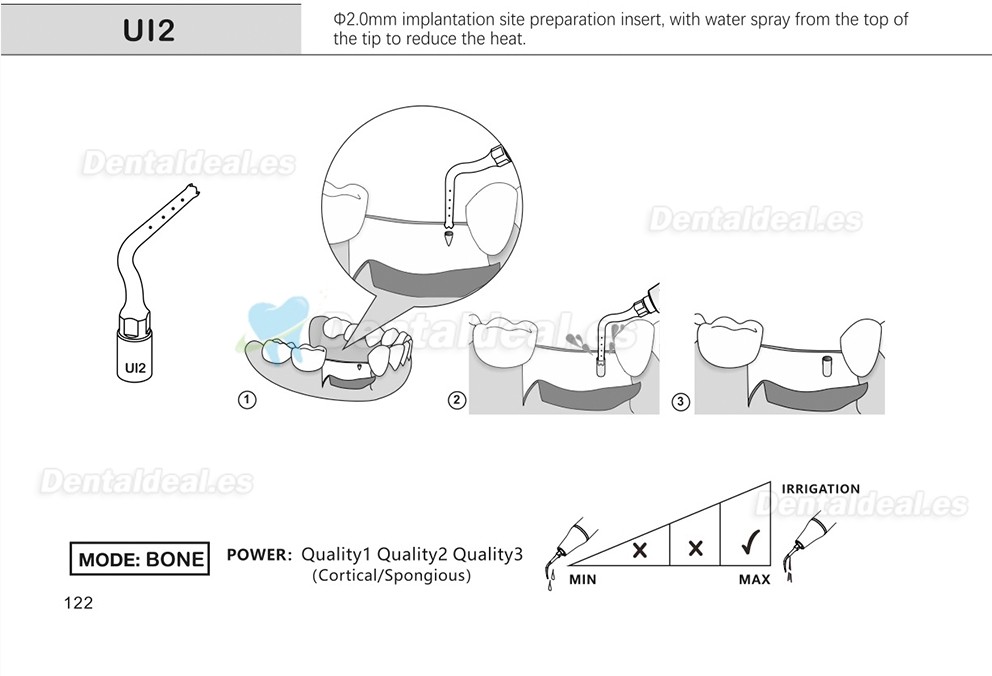 1Pcs Puntas para piezo cirugía para implante de elevación de seno para corte óseo Ul1 UI2 UI3 UI4 UI5 compatible con Mectron Woodpecker