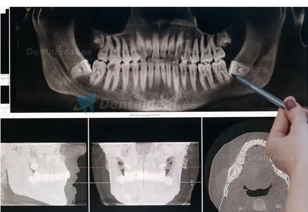 Refine MaxSurgery máquina de cirugía piezoeléctrica dental sistema de cirugía ósea piezoeléctrica ultrasónica 