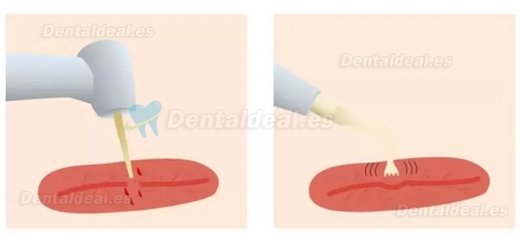 Refine MaxSurgery máquina de cirugía piezoeléctrica dental sistema de cirugía ósea piezoeléctrica ultrasónica 